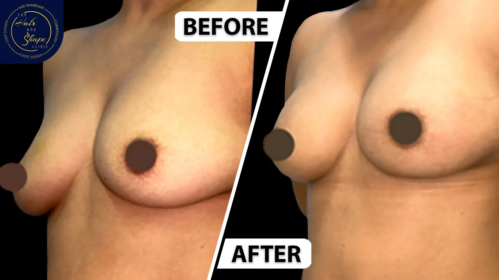 Breast Augmentation result2